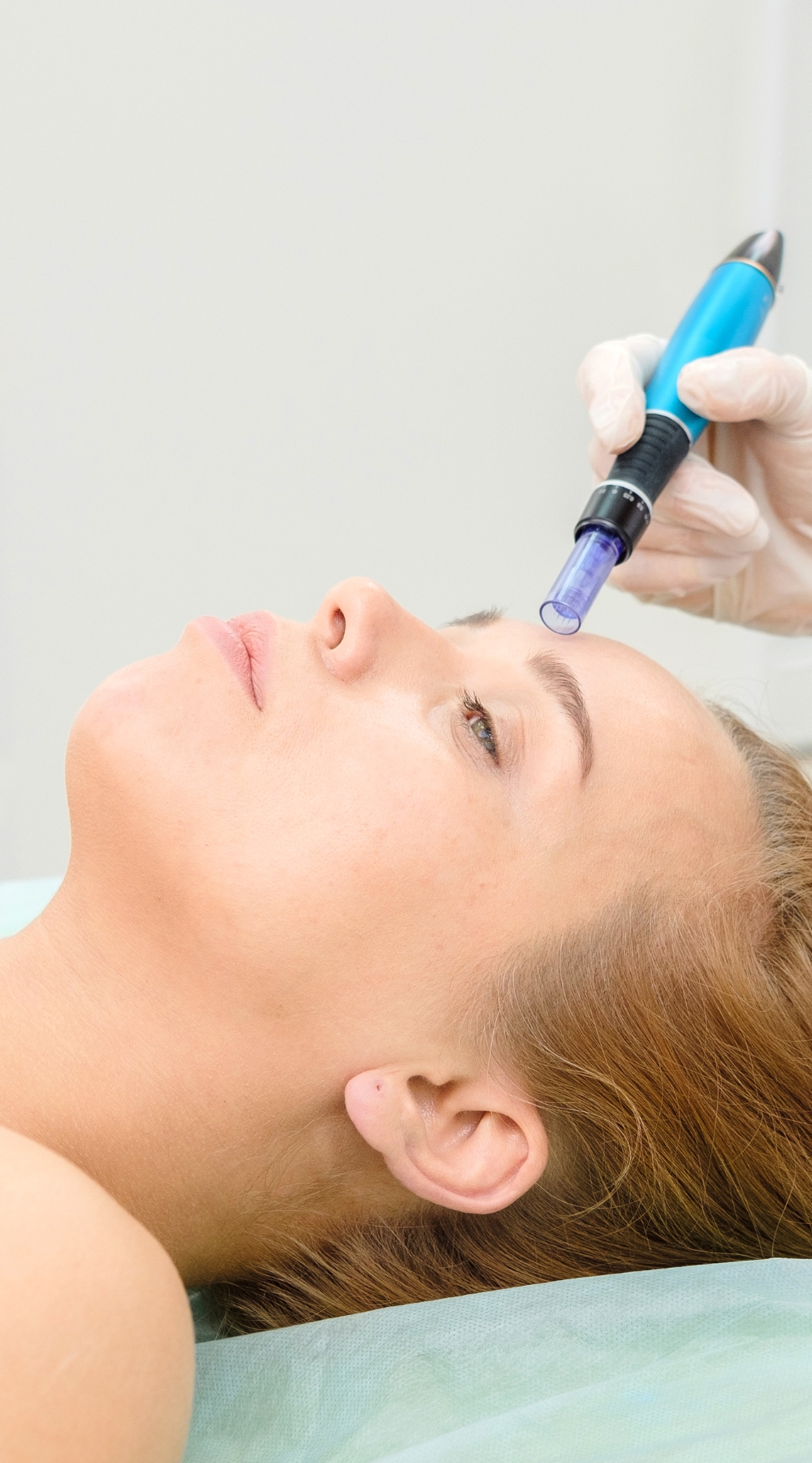 Collagen induction therapy (CIT) Bearwood