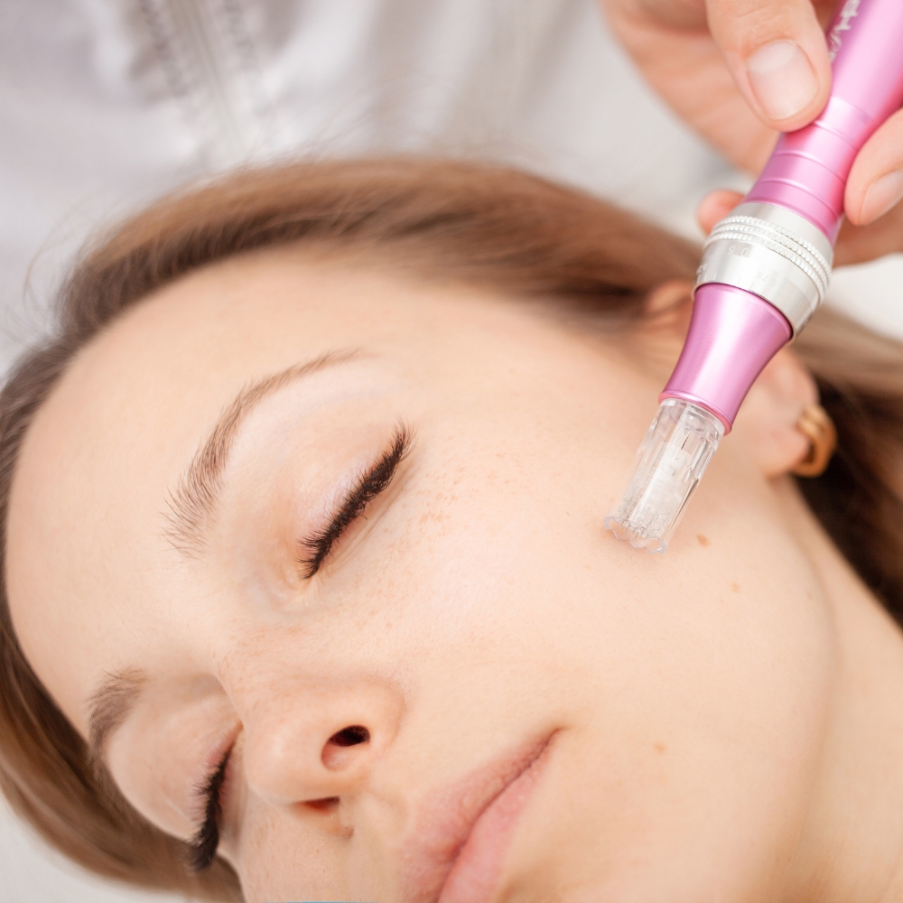 Microneedling Birmingham
