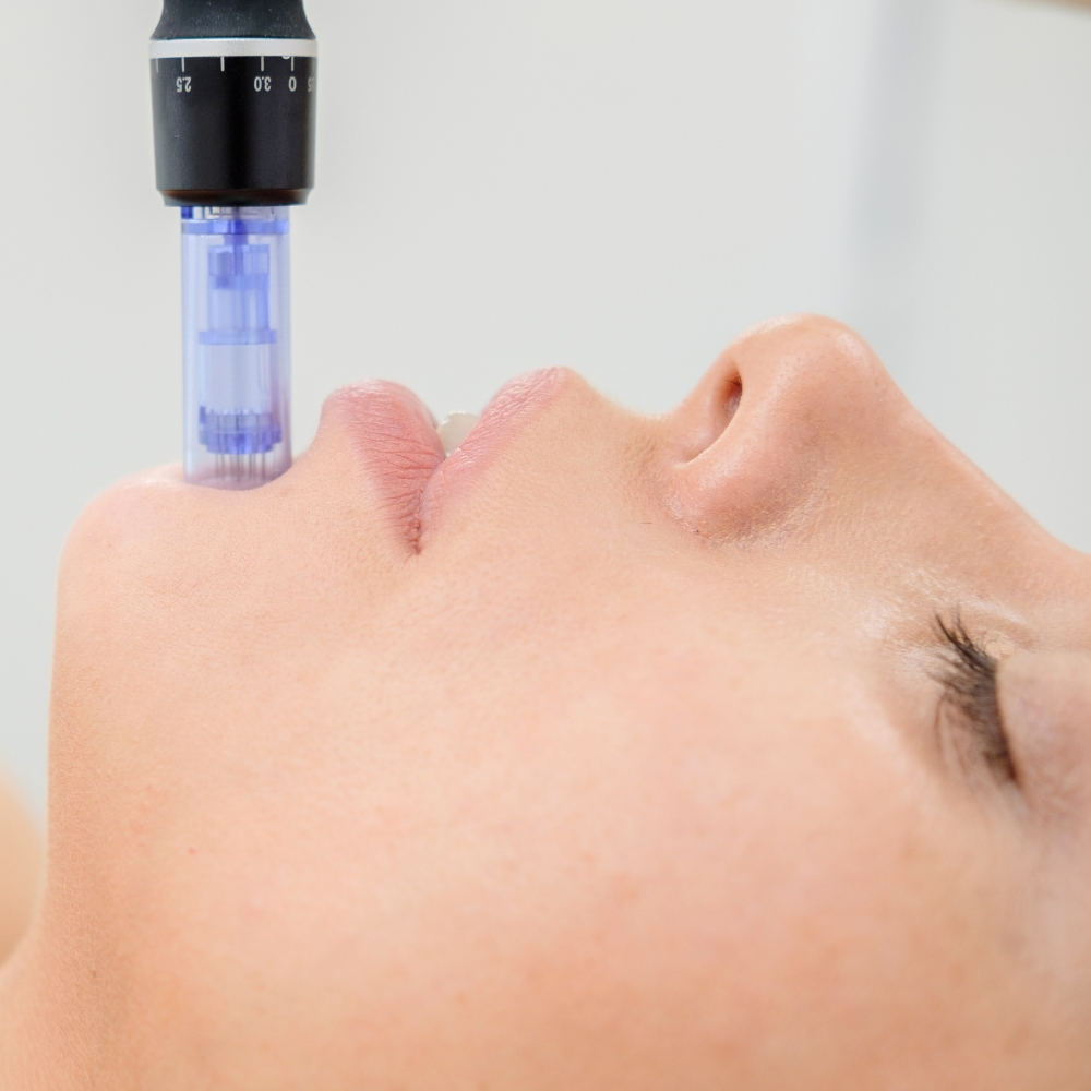 Microneedling Birmingham